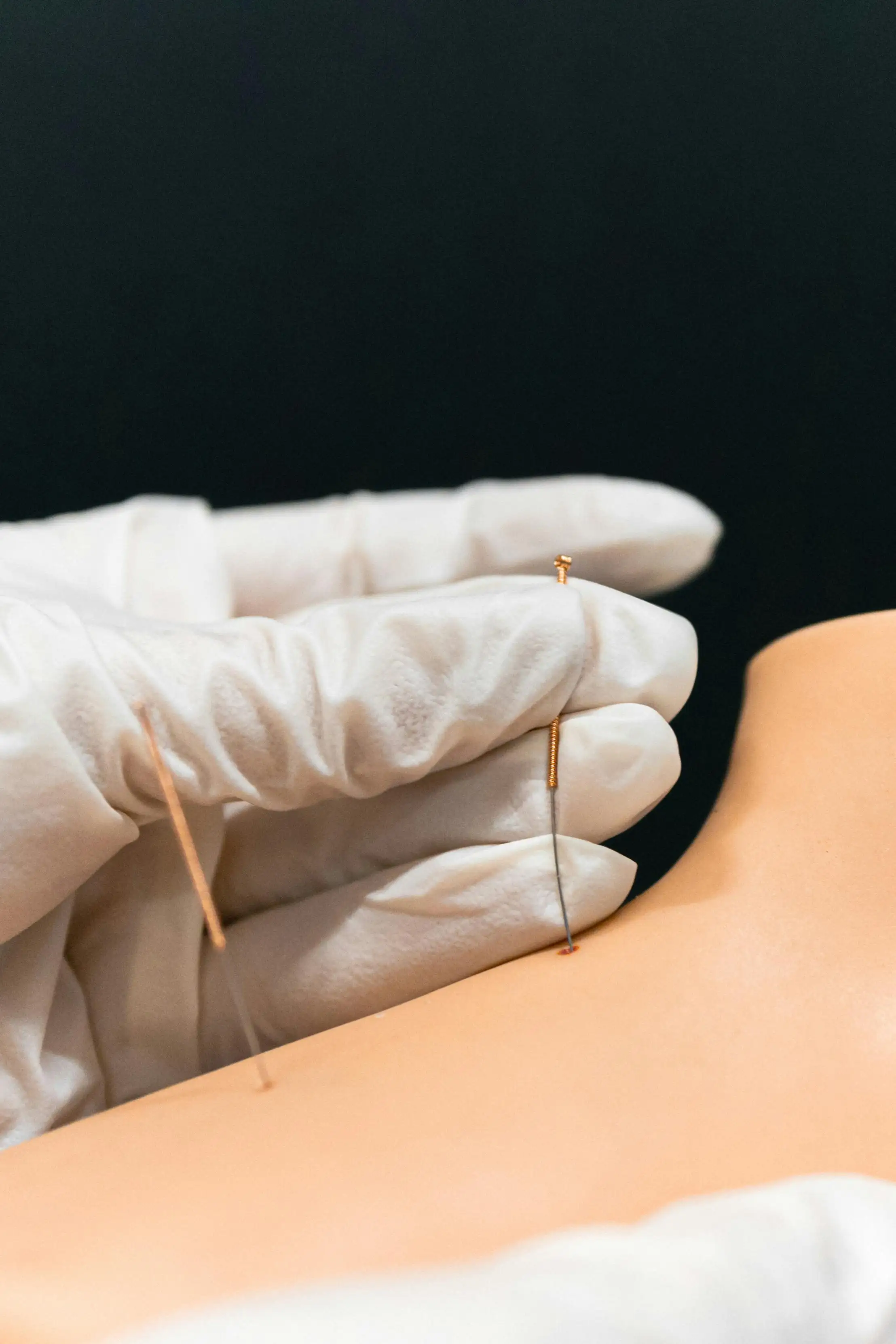 Dry Needling treatment at Integrative Health Solutions in Florence SC